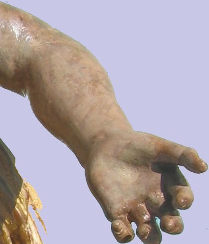 Arm nach Restauration