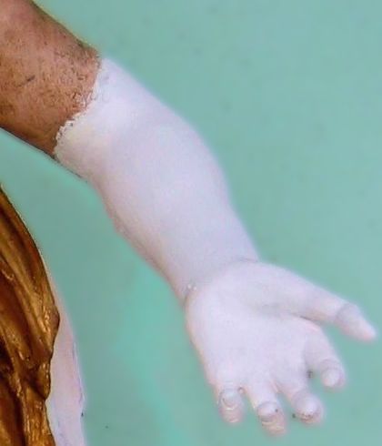 Arm vor Restauration