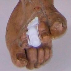 Fuß vor Restauration